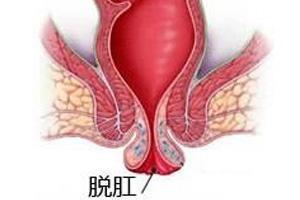 肛门口有个肉球突出是怎么回事，大概念是痔疮问题！